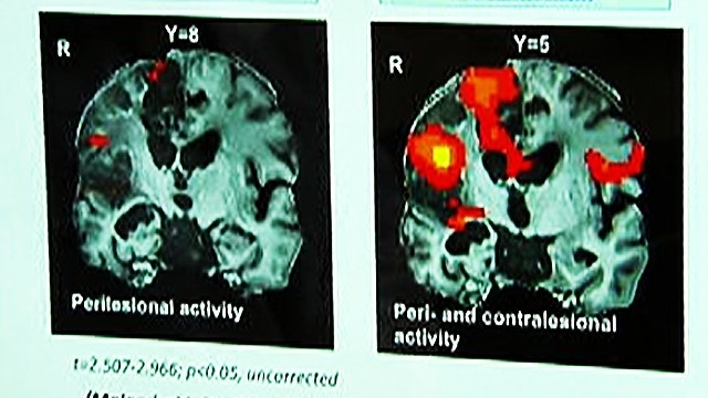 Brain imaging helps patients swallow post-stroke